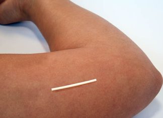 Breaking it Down: Insertion and Removal Process for Contraceptive Implants