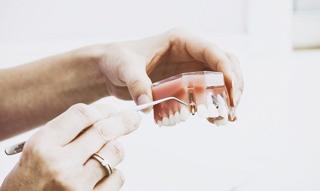 Top 4 Reasons To Get Dental Implants Today