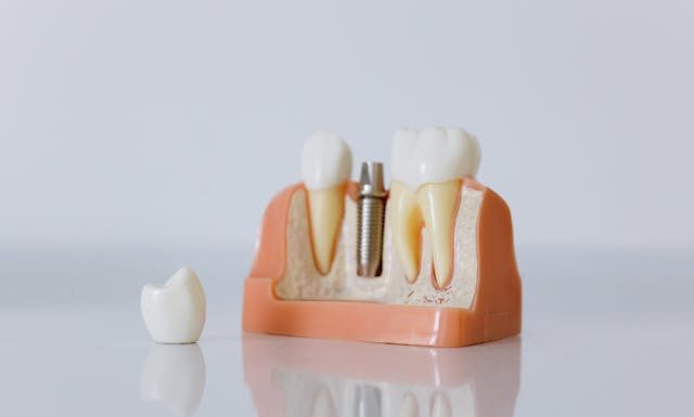 Caring for Your Dental Implants: Tips for Long-Lasting Results