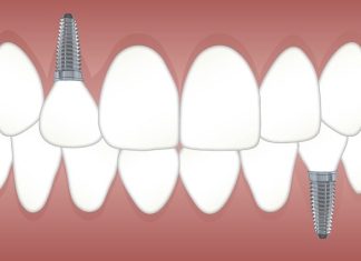 Improving Long-Term Success Rates in Implant Dentistry