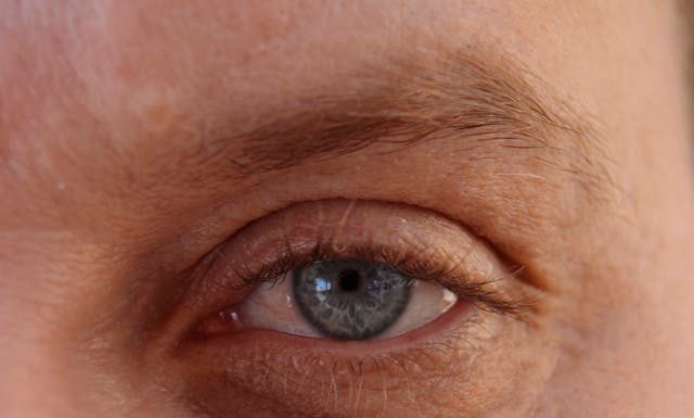 What Causes Droopy Eyelids and When Is Blepharoplasty Recommended?