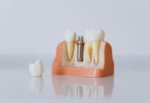 How to Know If You Are a Good Candidate for Dental Implants