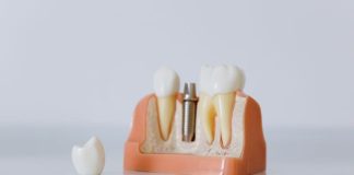 How to Know If You Are a Good Candidate for Dental Implants